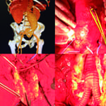 Aneurismas de aorta