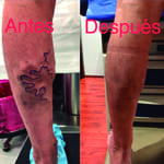 Tratamiento con Radiofrecuencia para varices