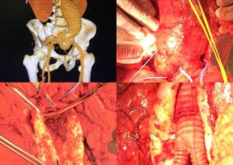 Aneurismas de aorta