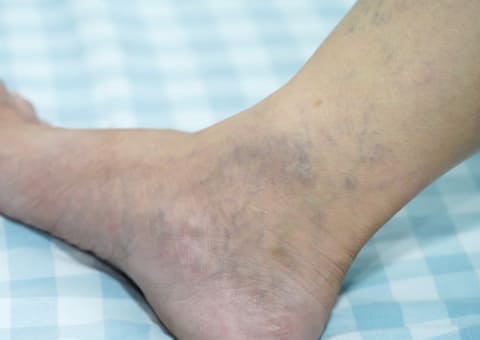 Angiología y cirugía vascular
