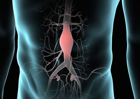 Angiólogo en CDMX en aneurisma de aorta