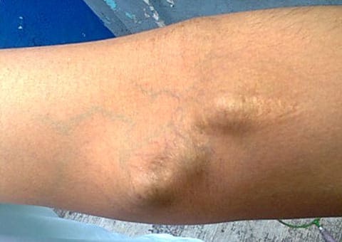 Angiólogo en CDMX en fistula arteriovenosa