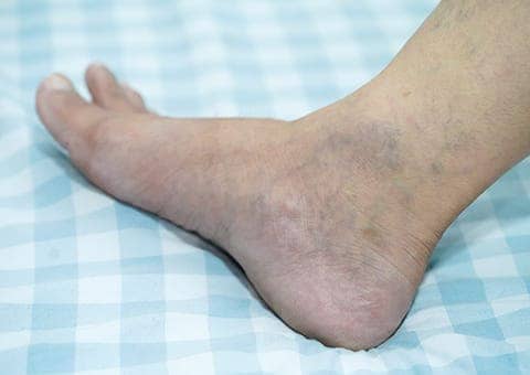Angiólogo en CDMX en tratamiento con láser para las varices