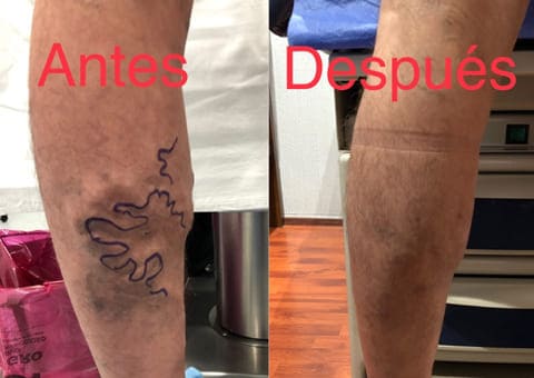 Tratamiento con Radiofrecuencia para varices